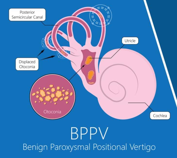 Ask the Melbourne Vestibular Clinic - What is the best way to treat BPPV?