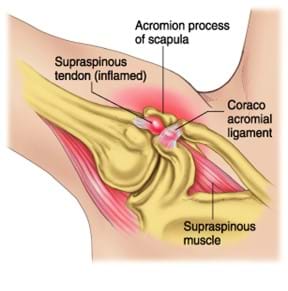 Treating Shoulder Pain by understand the joint first